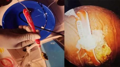 Meghalaya: Toothbrush removed from woman’s stomach without surgery